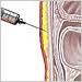  Abdominal Wall Fat Pad Biopsy 