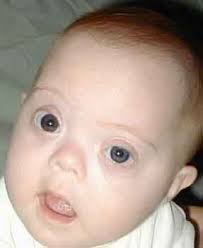 Down syndrome symptoms, - via Daymix
