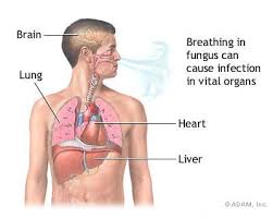  coccidioidomycosis  is