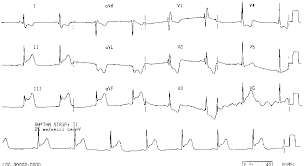 http://www.ecglibrary.com/ecgs/infmi.gif