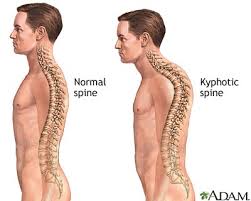 Kyphosis: The “Hunch-back” - via Daymix