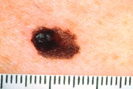 An example of how  melanoma 