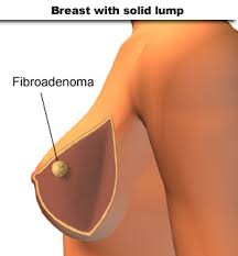 http://www.riversideonline.com/source/images/image_popup/hb7_fibroadenoma.jpg