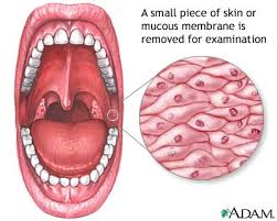 Mucosal biopsy - via Daymix