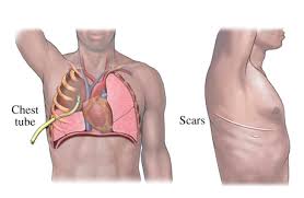 Lung surgery : Chest tube