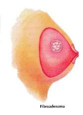 http://www.stonybrookphysicians.com/center/images/breast-care/BreastLump3.jpg