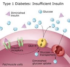  Type 1 Diabetes 