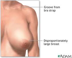  breasts  (macromastia),