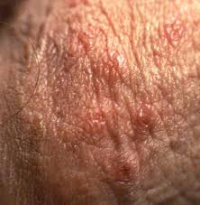 Primary  Genital Herpes 