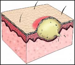  pustule 