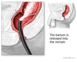 Barium Enema