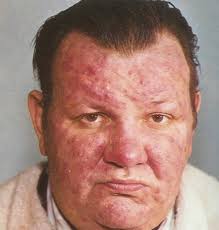 Picture of a Man With  Rosacea 