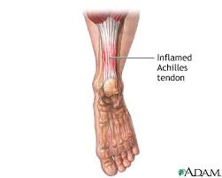  Achilles tendinitis  Images