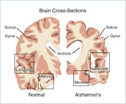 Healthbeat  Alzheimer x26s   Studies    