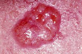  Basal cell carcinoma 