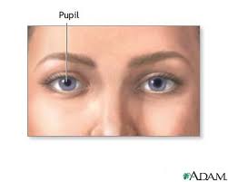 Normal pupil -  Anisocoria 