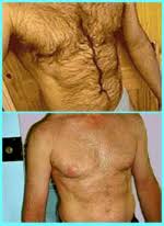 male chest hair