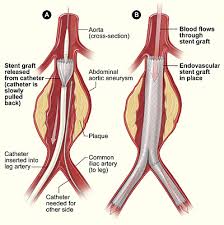  Endovascular Repair . The
