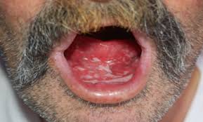 http://dermatology.cdlib.org/1411/letters/pellagra/1c.jpg