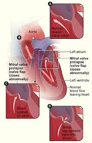  mitral valve  separating