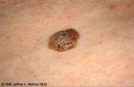 Seborrheic keratosis 