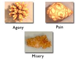  kidney stones 