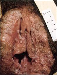  Genital warts 