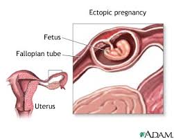 Ectopic pregnancy - via Daymix