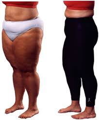 cellulite