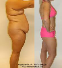 Performing Liposuction