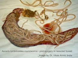 http://www.holistic-wellness-basics.com/images/ascariasis-roundworms.jpg