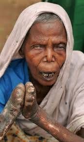 Understanding Leprosy - via Daymix