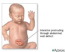  Lump  in the  abdomen 