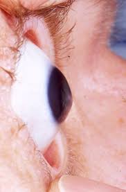  Keratoconus  (from Greek