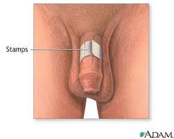 Erection self test
