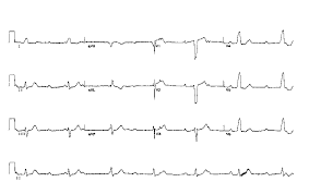 http://www.ecglibrary.com/ecgs/chb4.gif