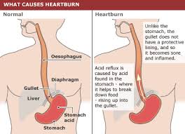 Heartburn and Gastric Reflux - - via Daymix