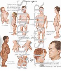  Achondroplasia 