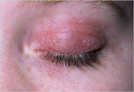 theory that chronic  eczema 