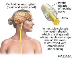  Multiple Sclerosis 
