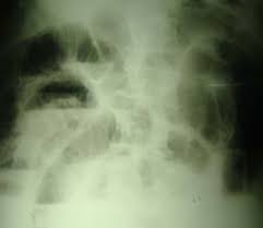 1 X-ray  abdominal film  showed