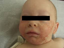 http://www.dermpathmd.com/photos/acrodermatitis_enteropathica_clin2_1a.jpg