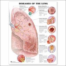  Diseases  of the Lung