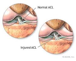  Anterior Cruciate Ligament 