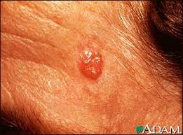  Basal Cell Carcinoma  - face