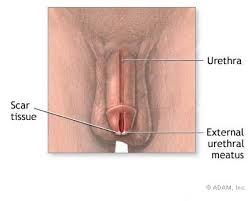  Meatal stenosis 