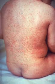  Rubella  Skin Rash Picture :