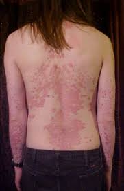  Psoriasis  Treatment the