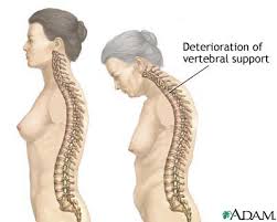 Osteoporosis - via Daymix