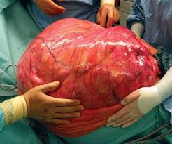 unusual ,  tumor  , huge